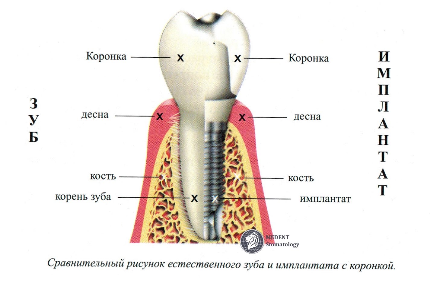 Корень зуба крепится к кости